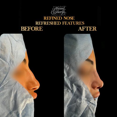 متى تظهر نتائج عملية تجميل الأنف في الرياض